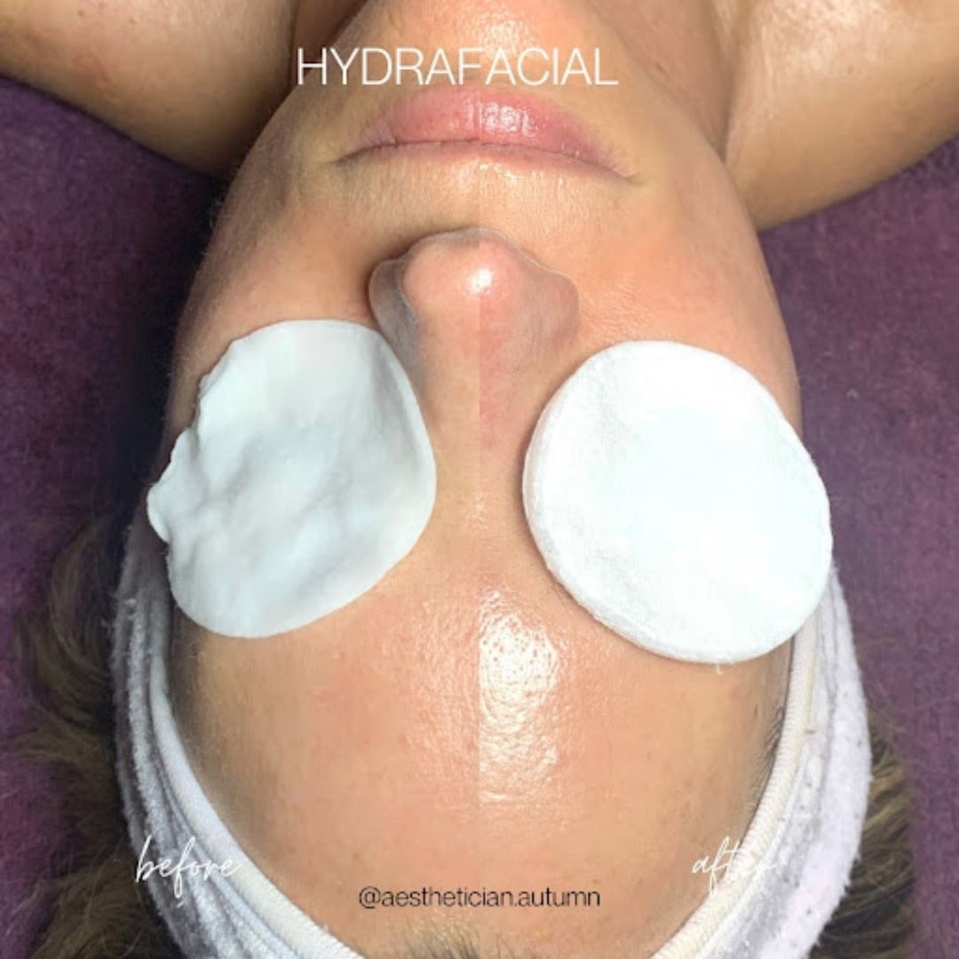 Before and after HydraFacial treatment