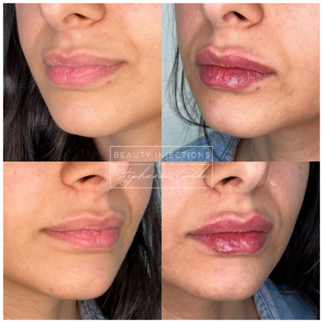 Before and after cosmetic injection in lips