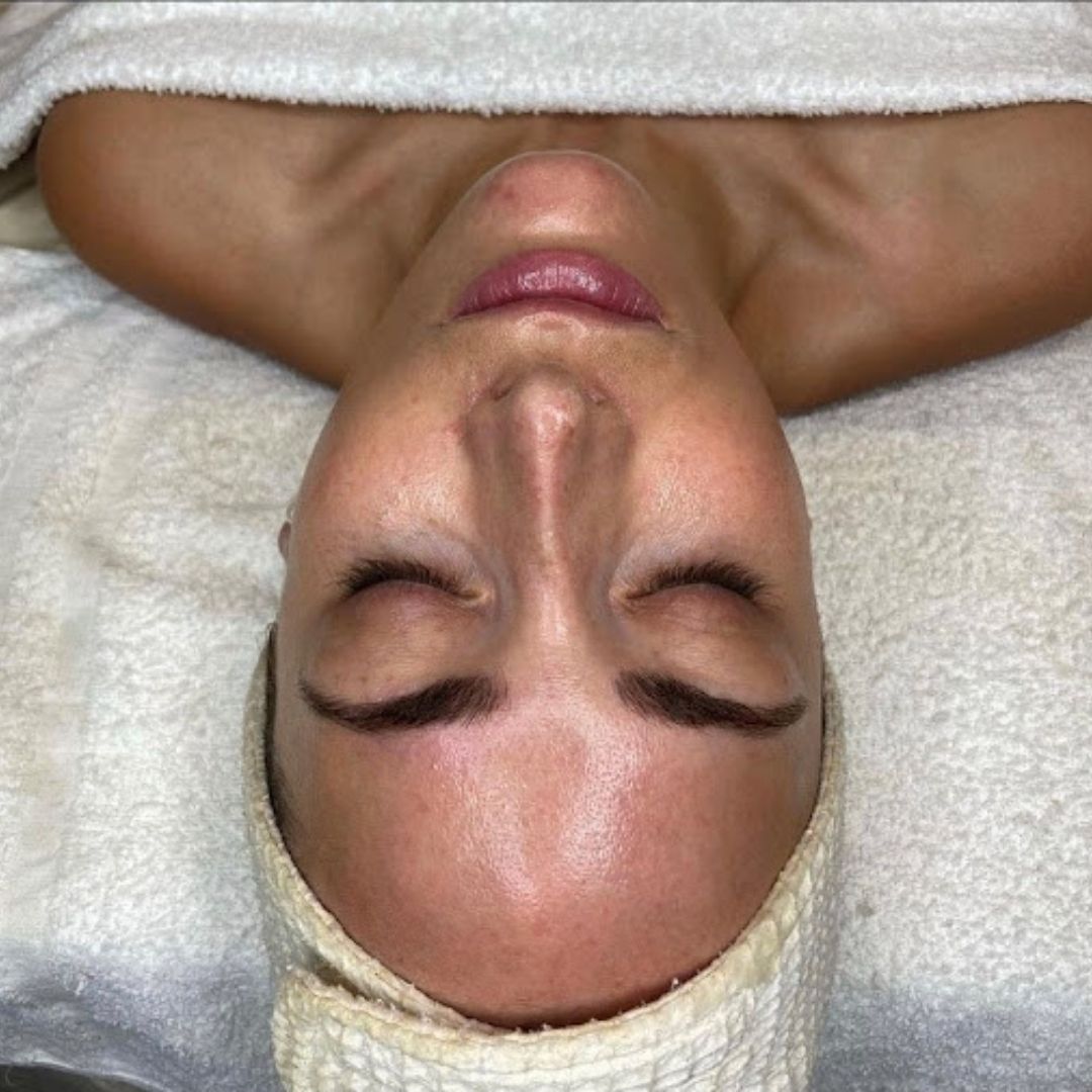 After a HydraFacial treatment