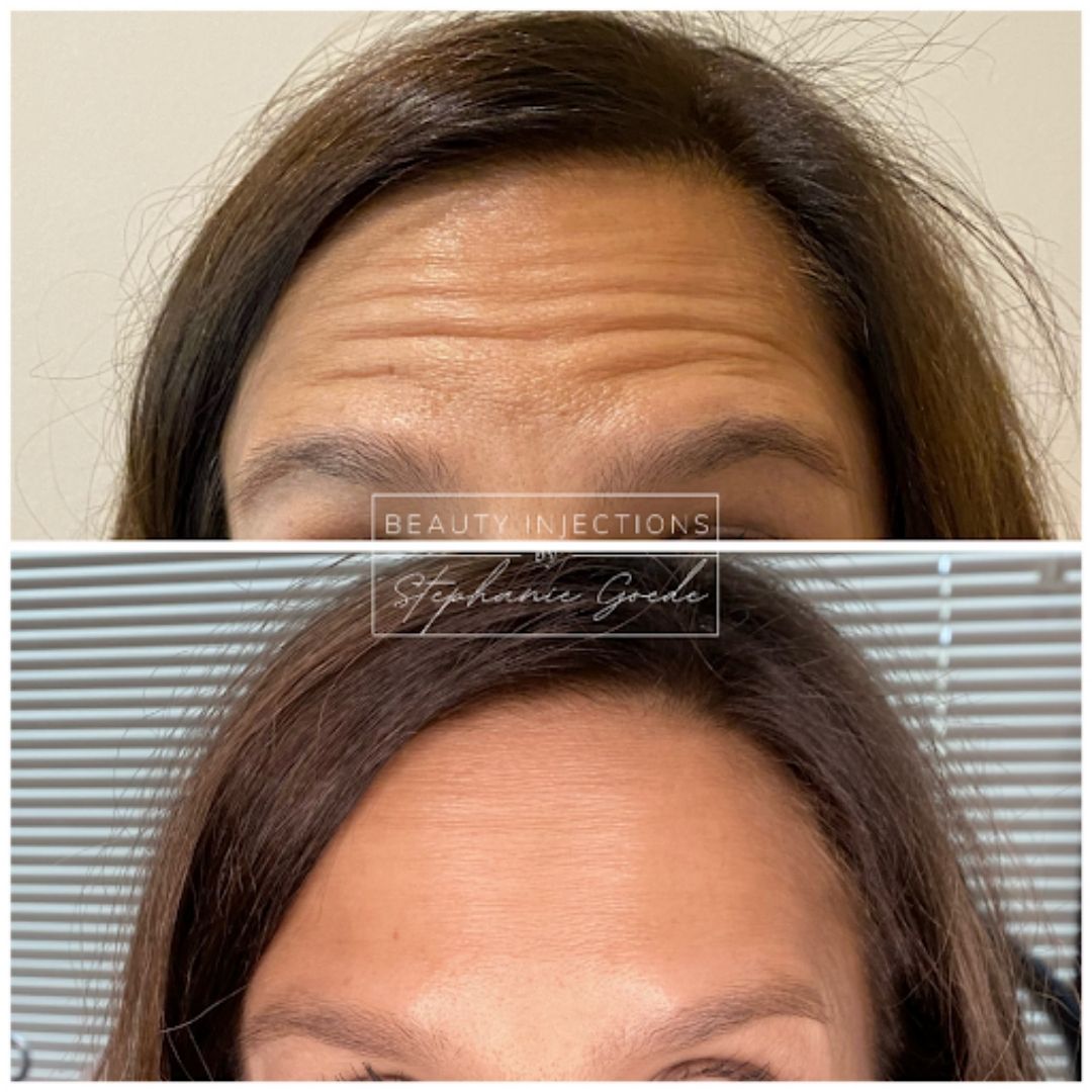Before and after forehead Botox injections
