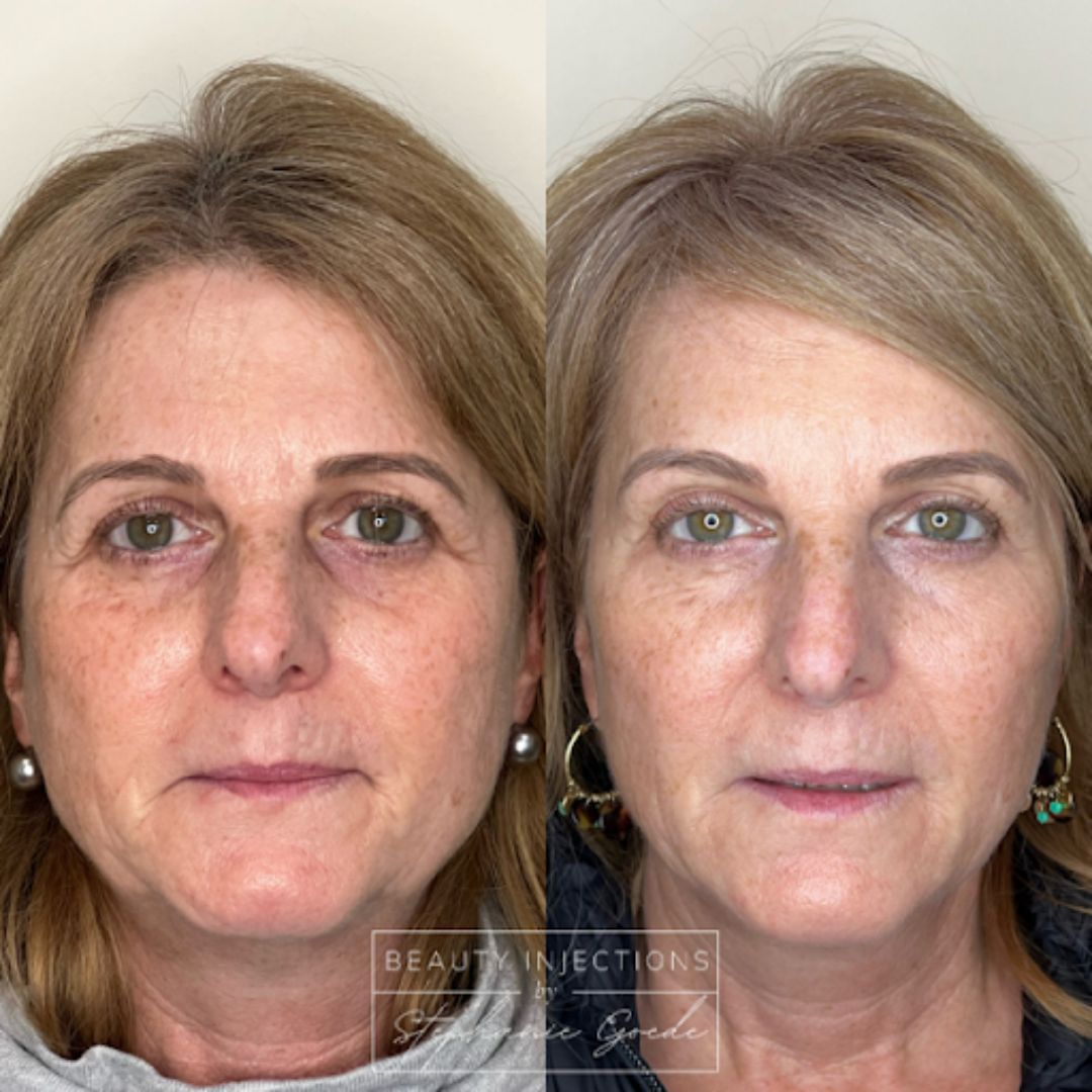 Before and after of a woman who received Botox