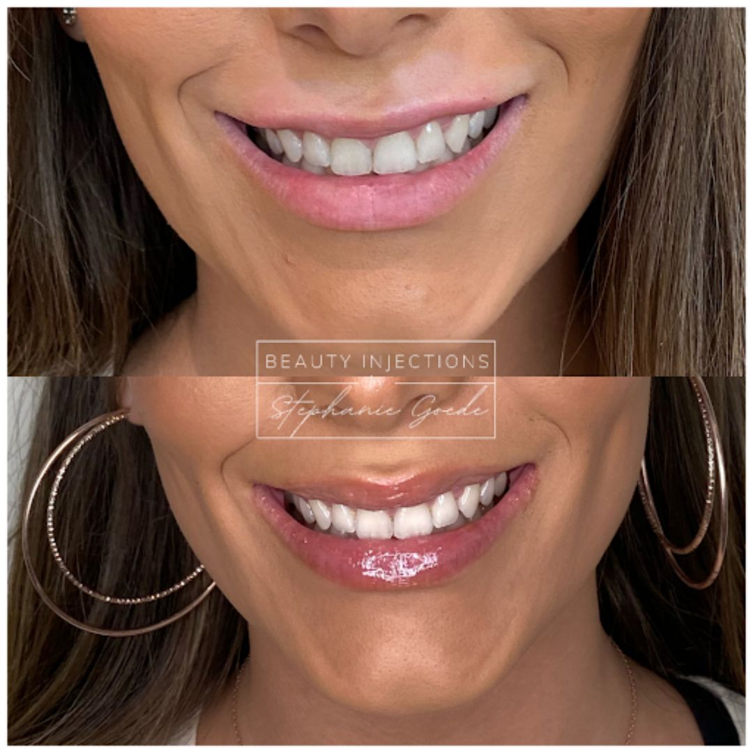 Woman smiling showing before and after Botox.
