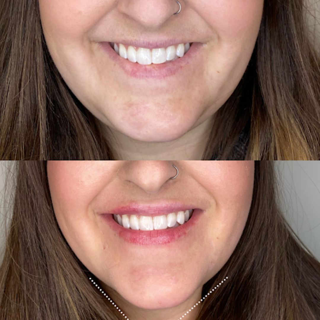 a before and after of Dermal Filler Lip Treatments