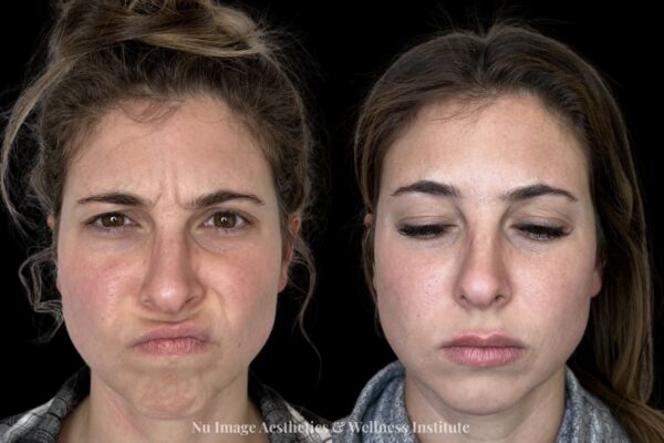 Botox-001