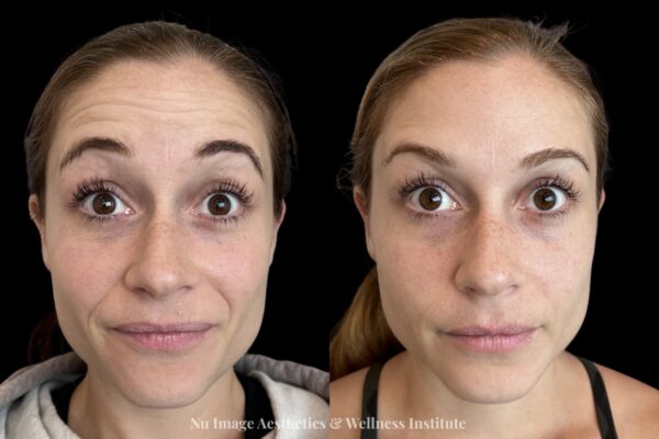 Botox-003