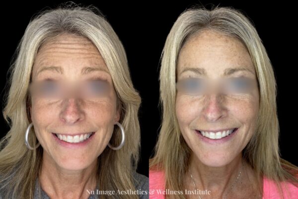 Botox-004