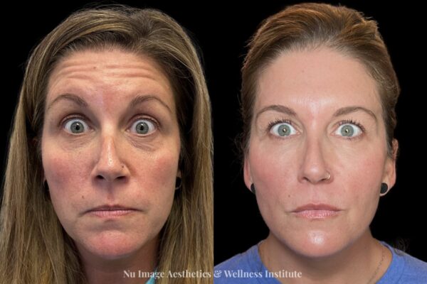 Botox-005