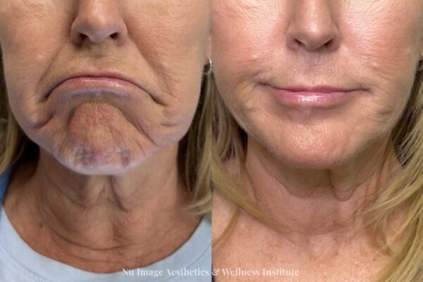 Botox-007