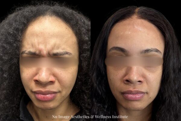Botox