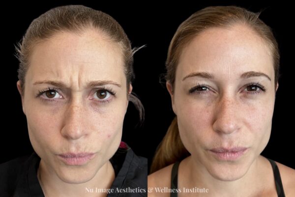 Botox(1)-001