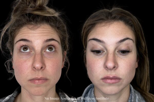 Botox(1)