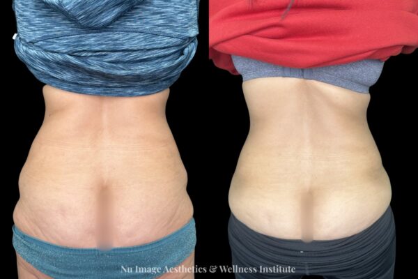 Coolsculpt
