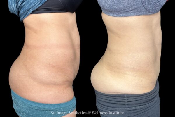 Coolsculpt(1)