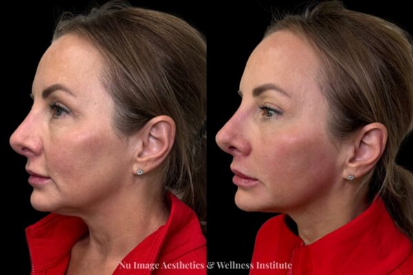 Facial Balancing-006