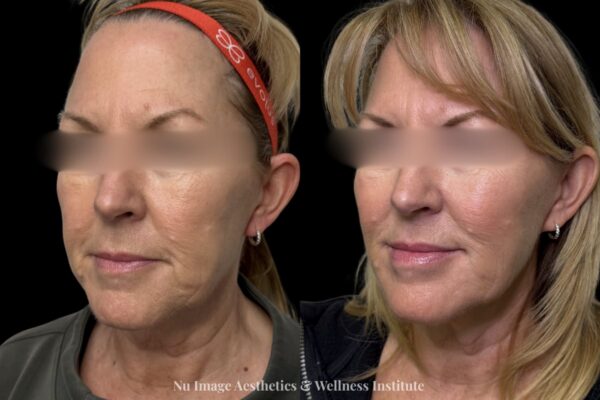 Facial Balancing(1)-004