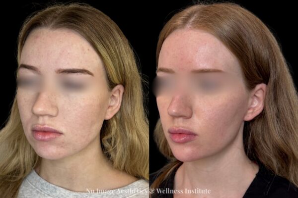 Facial Balancing(1)