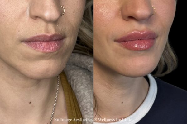 Lip Filler-001