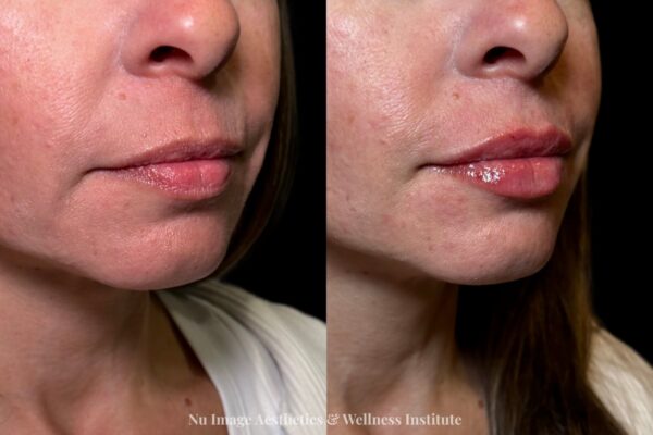 Lip Filler