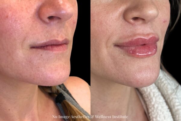 Lip filler-003