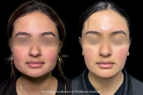 Masseter Botox