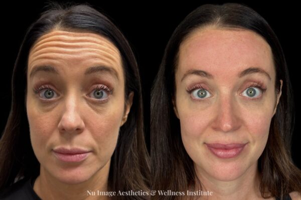 botox b:a 1