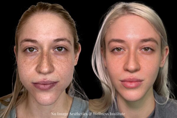 botox b:a 2